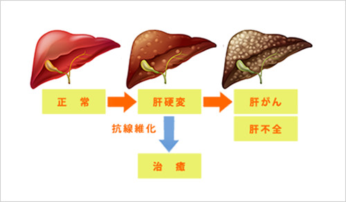 肝硬変の原因